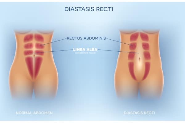 What Non-Surgical Options Are Available for Diastasis Recti Enfield?