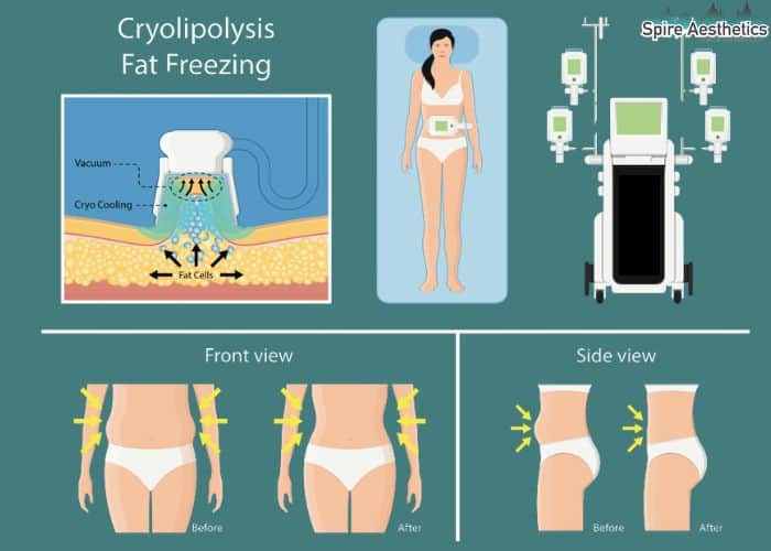 Image of diet and fat freezing combined for best results for Spire Aesthetics Enfield