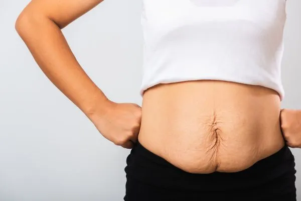 Image of a woman's stomach after weight loss with sagging skin following a gastric band Enfield
