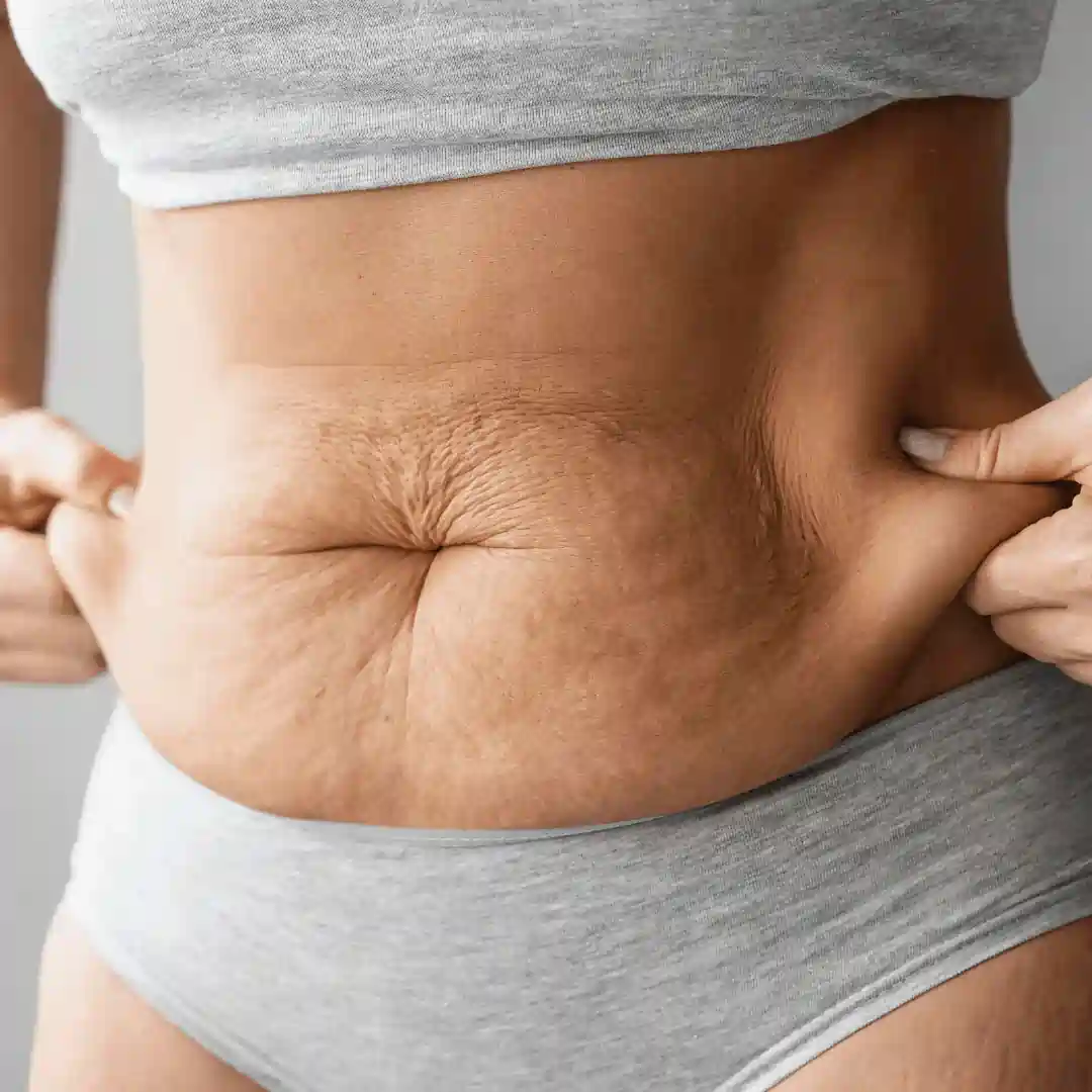 Is It Normal to Have Loose Skin After Pregnancy Enfield?
