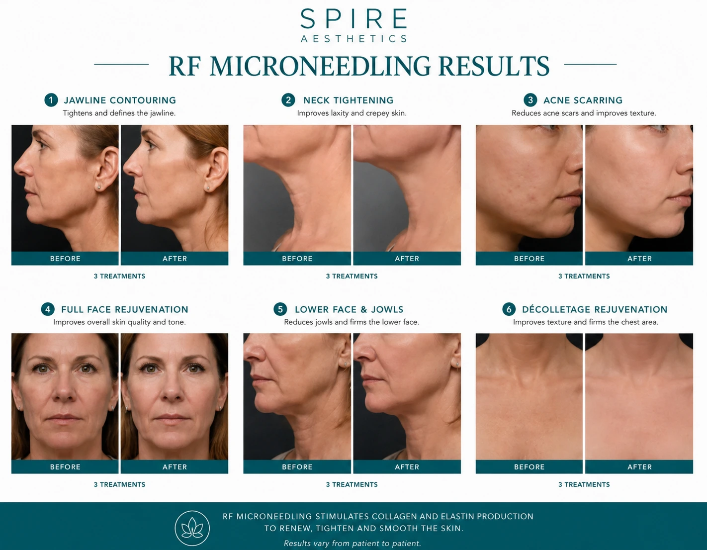 RF Microneedling Skin tightening Enfield results