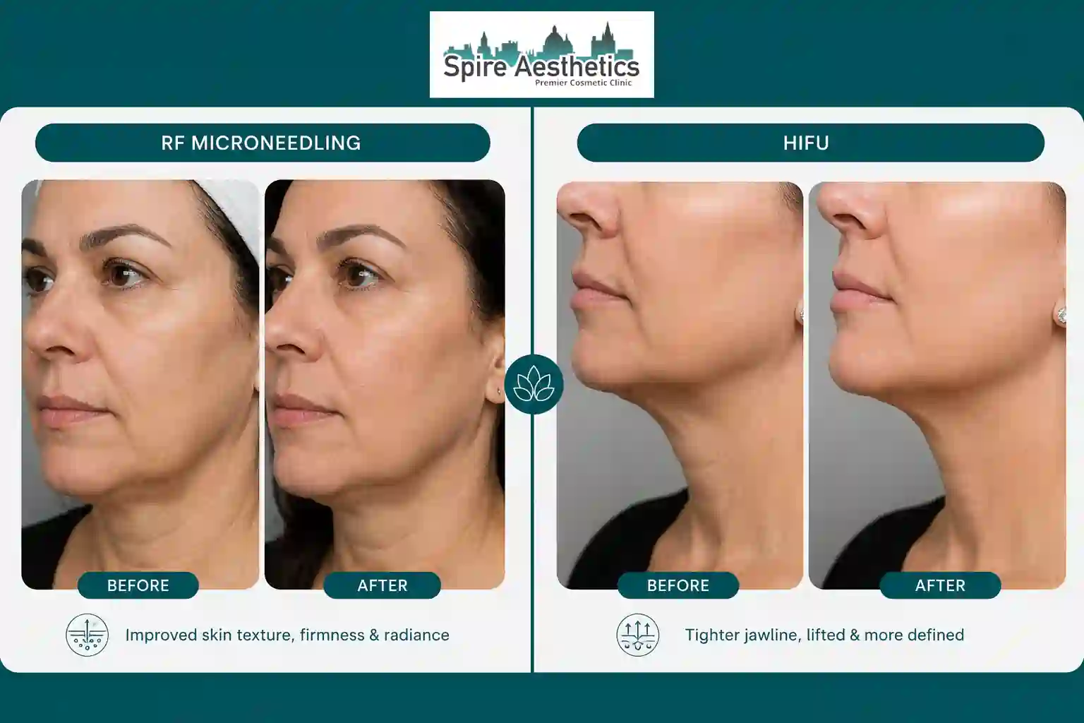 Can RF Microneedling and HIFU Be Combined Enfield?