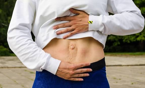 When Could Diastasis Recti Be the Missing Piece of the Puzzle Enfield?