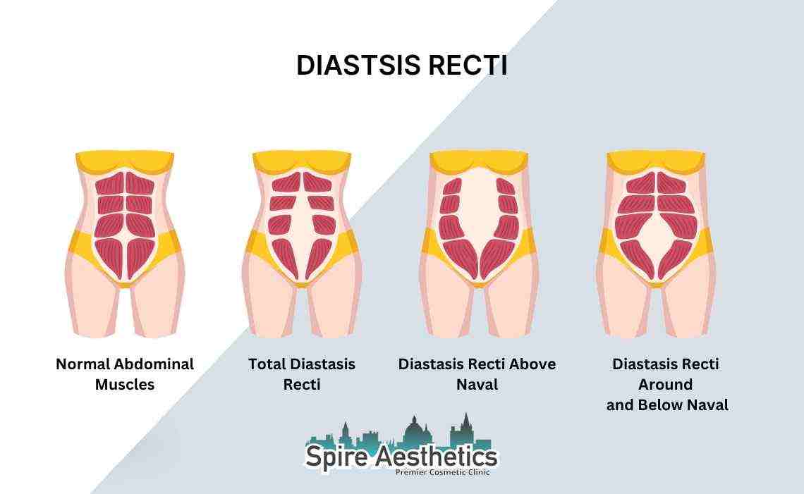 Is Non-Surgical Diastasis Recti Treatment Right for You? Common Concerns Answered Enfield